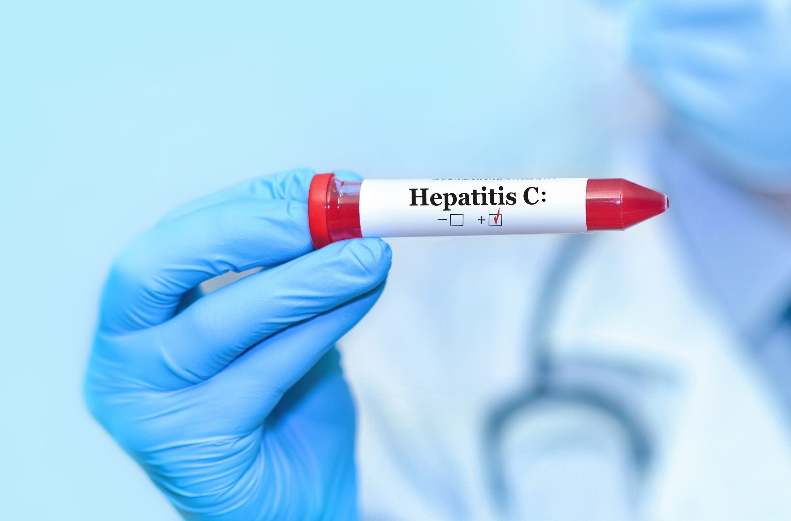 Hepatitis C Burden in Orange County, Florida: Implications for the Latino Community and the Orange County Jail